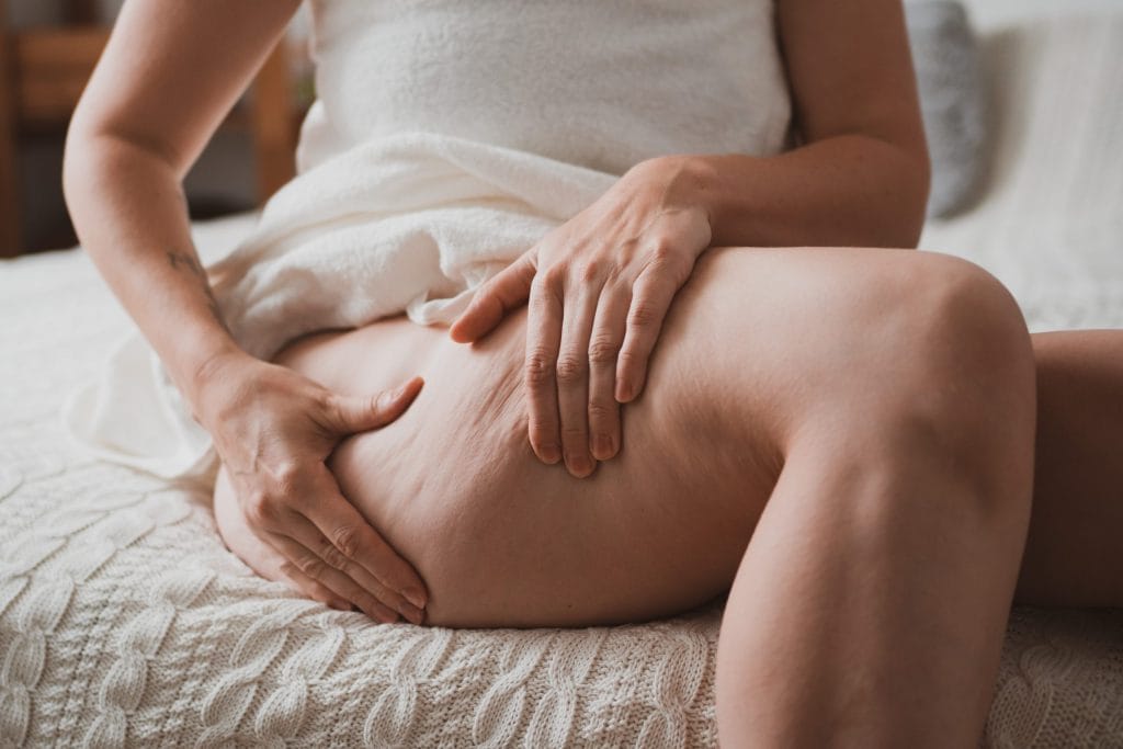What Causes Cellulite