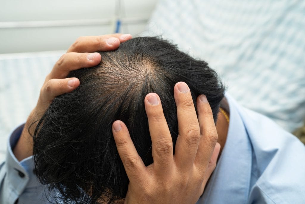 Does Testosterone Replacement Therapy (TRT) Cause Hair loss?