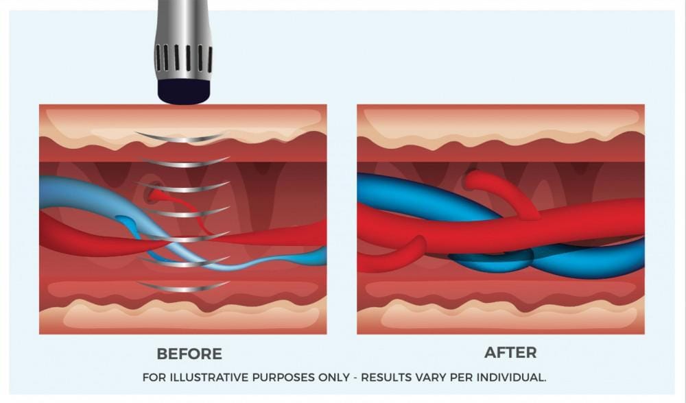 Shockwave Therapy for ED – Available in-person at Costa Mesa, CA clinic